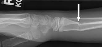 Maybe you would like to learn more about one of these? What Can Cause A Wrist Fracture