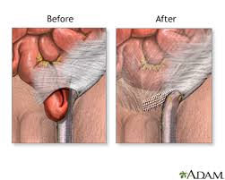 Image result for Inguinal hernia man