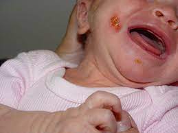 We did not find results for: Focar De Stafilococ Auriu In Capitala Care Este Situatia La Botosani Si La Ce Pericol Pot Fi Supusi Bebelusii Despre Botosaniul Interzis