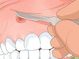 How To Get Rid Of A Gum Boil Gum Get Rid Of Boils Boil