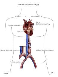 Abdominal Aortic Aneurysm Cardiovascular Medbullets Step 2 3