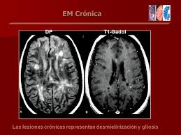 Capítulo 4 el diagnóstico diferencial de la esclerosis múltiple pág. Irm En La Esclerosis Multiple Ppt Video Online Descargar
