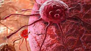 7 tanda awal kanser yang wanita mungkin salah anggap sebagai simptom mengandung. Jarang Diketahui Berikut 4 Gejala Kanker Darah Seperti Yang Diidap Ani Yudhoyono Global Liputan6 Com