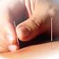 Dry Needling - Advanced Upper Body Course event image