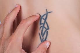 The feeling of each short pulse is usually described as feeling like the 'snap' of a rubber band on the skin. Revlite Q Switched Nd Yag Laser Dermatology And Laser Centre Of La