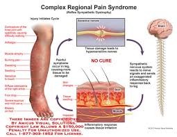 Complex Regional Pain Syndrome Crps Palo Brea Pain Rehabilitation