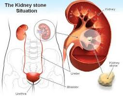 Pin By Blogging On My Helth Kidney Stones Remedy Nursing Care Plan Kidney Stones