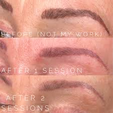 We tried many different lasers and settled on picosure as it provided the best results in trials. Saline Tattoo Removal Non Laser Tattoo Removal In Portland