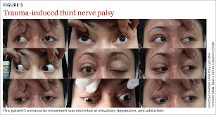 Image result for Pupillary Paralysis