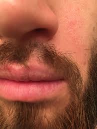 Men's facial hair growth is not only counted on the genes. Patch On Mustache With Stunted Hairs It S Like The Hairs Just Refuse To Grow More Than A Couple Mm What S The Deal Beards