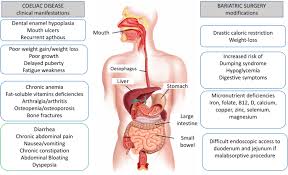 A systematic review and metaanalysis. Celiac Disease And Obesity Is Bariatric Surgery An Option Springerlink