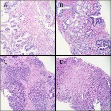 Webpathology is a free educational resource with 11234 high quality pathology images of benign and malignant neoplasms and related entities. Prostate Cancer Grade Assessment Panda Challenge Kaggle