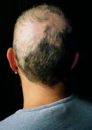 Frequently the hair that grows back after repeated pulling has lost its pigment and grows in white. Trichotillomania Wikipedia