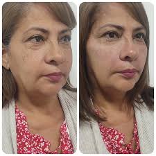 ✨ ¡Renueva tu rostro con Verticalización Facial! ✨ El Dr. Gustavo Ulloa  combina hilos tensores y ácido hialurónico para devolver la firmeza y  frescura a tu piel. Este procedimiento redefine tu rostro,
