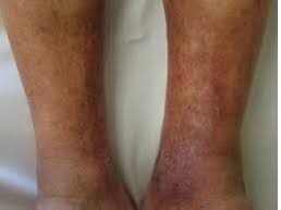 Image result for Lipodermatosclerosis