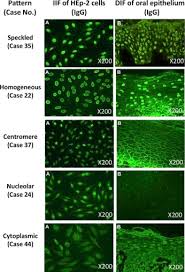 Image result for ANA Staining Pattern