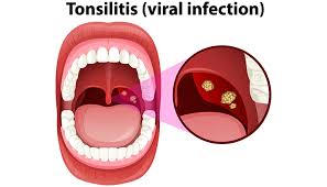 Image result for Tonsillitis