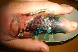 Another type of mrsa infection has occurred in the wider community — among healthy people. Finger With Phlegmon Resulting Sepsis Doccheck
