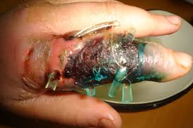 Finger, although patients who are immunocompromised may have a more indolent and chronic presentation, and a history of trauma in these patients may be remote or absent. Finger With Phlegmon Resulting Sepsis Doccheck