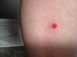 Insektenstich Biss Gefahrlich Gesundheit Arzt Angst