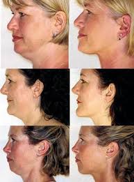 Face Rubbing Get A Non Surgical Turtle Neck Lift Via This Minimal Facial Exercise Facial Exercises Face Wrinkles Face Exercises