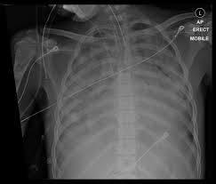 Image result for XRay Changes in Rheumatic Conditions