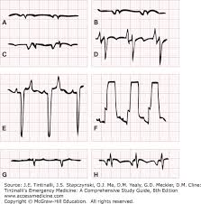 Image result for Transcutaneous Pacing
