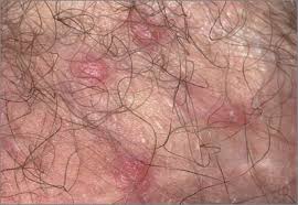 Image result for scabies on genitals