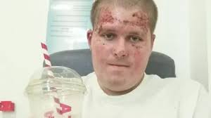 Walsall explosion victim 'still has bad days' after coma recovery