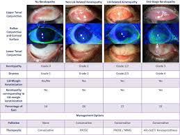 Chronic Ocular Sequelae Of Stevens Johnson Syndrome In Children Long Term Impact Of Appropriate Therapy On Natural History Of Disease American Journal Of Ophthalmology