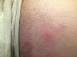 I do take tips and advice so thanks for your input and thank. Ingrown Hair Ingrown Hair Bumps On Buttocks