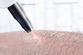 If you're interested in laser hair removal, choose a doctor who's board certified at the consultation, discuss a treatment plan and related costs. Laser Hair Removal Series How To Prepare Hillandale Primary Care
