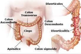 Las paredes del colon sigmoide son musculares, y se contraen para incrementar la presión en el interior del colon, haciendo que los excrementos se muevan hacia el recto. Enfermedad Diverticular La Diverticulosis Del Colon Es Un Problema Comun Que Afecta A Cerca Del 50 De Los Mayores De 60 Anos De Edad Y A Casi Todos De 80 Anos Solo