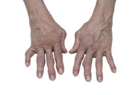 Check spelling or type a new query. Artritis De La Mano Sintomas Ccm Salud