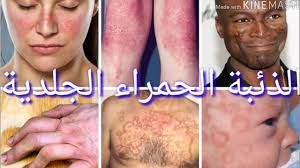 The disease has a wide spectrum of organ involvement with cutaneous, muskuloskeletal, renal, neurological, hematological and pulmonary manifestations. Ø§Ù„Ø°Ø¦Ø¨Ø© Ø§Ù„Ø­Ù…Ø±Ø§Ø¡ Ø§Ù„Ø¬Ù„Ø¯ÙŠØ© Cutaneous Lupus Ø§Ù†ÙˆØ§Ø¹Ù‡Ø§ ÙˆØ£Ø¹Ø±Ø§Ø¶ ÙƒÙ„ Ù†ÙˆØ¹ Ùˆ Ø·Ø±Ù‚ Ø§Ù„Ø¹Ù„Ø§Ø¬ Youtube