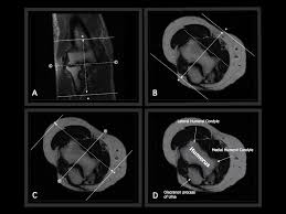 Image Result For Mri Shoulder Coronal View Mri Radiology Imaging Elbow
