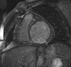 Die häufigsten erreger einer myokarditis sind dabei diejenigen viren, die auch einen. Kardio Mrt Radiologie Stuttgart Radiologie Im Cityplaza