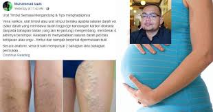 Kondisi ini bisa disebabkan oleh berbagai macam hal mulai dari gaya hidup hingga kaki bengkak adalah kondisi medis ketika terjadi penumpukan cairan pada kaki. Urat Betis Timbul Masa Mengandung Perlukah Dirisaukan Mudaratkah Doktor Jelaskan Sebab Cara Elak Pa Ma