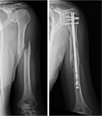 Image result for Humerus Bone