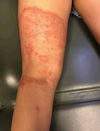 A small itchy red patch on your skin that passes quickly is usually nothing to worry about. 6 Year Old Girl Presents With Itchy Rash On Leg