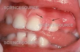 Image result for granuloma gum disease