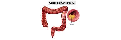 Image result for Colorectal Cancer