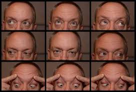 Image result for Pupillary Paralysis