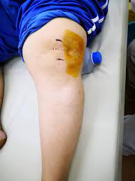 Simak ulasan di bawah ini untuk mengetahui apabila sakit lutut tidak kunjung sembuh, terasa panas, dan nyeri luar biasa segera periksakan ke dokter. 1 Punca Penyebab Sakit Dr Ghazali Atan M D Turkey Facebook