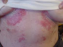 Image result for Candidiasis under breasts