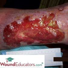 Venous Leg Ulcers Woundeducators