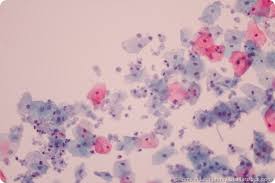 Image result for trichomonas images