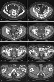 They support the pelvic organs especially during increases in intra abdominal pressure and also aid in urinary and faecal. Pelvis Oncohema Key