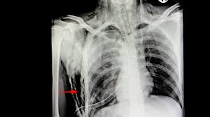 Subcutaneous Emphysema Symptoms Causes Diagnosis Treatment And Coping