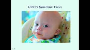 Epicanthic folds are sometimes one of the features of certain medical conditions, especially congenital anomalies. Flat Nasal Bridge And Epicanthal Folds Ultrasound Cute766